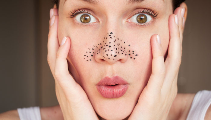 Blackheads-Causes And Tips To Deal With Them