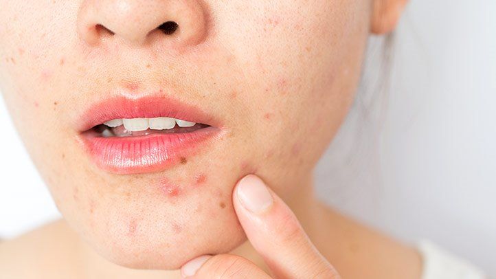 What are Blackheads?
